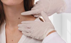 Home 6 Skin Tags